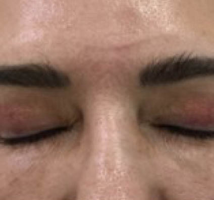 Alma Hybrid Scars after 5 sessions_Dr Arellano
